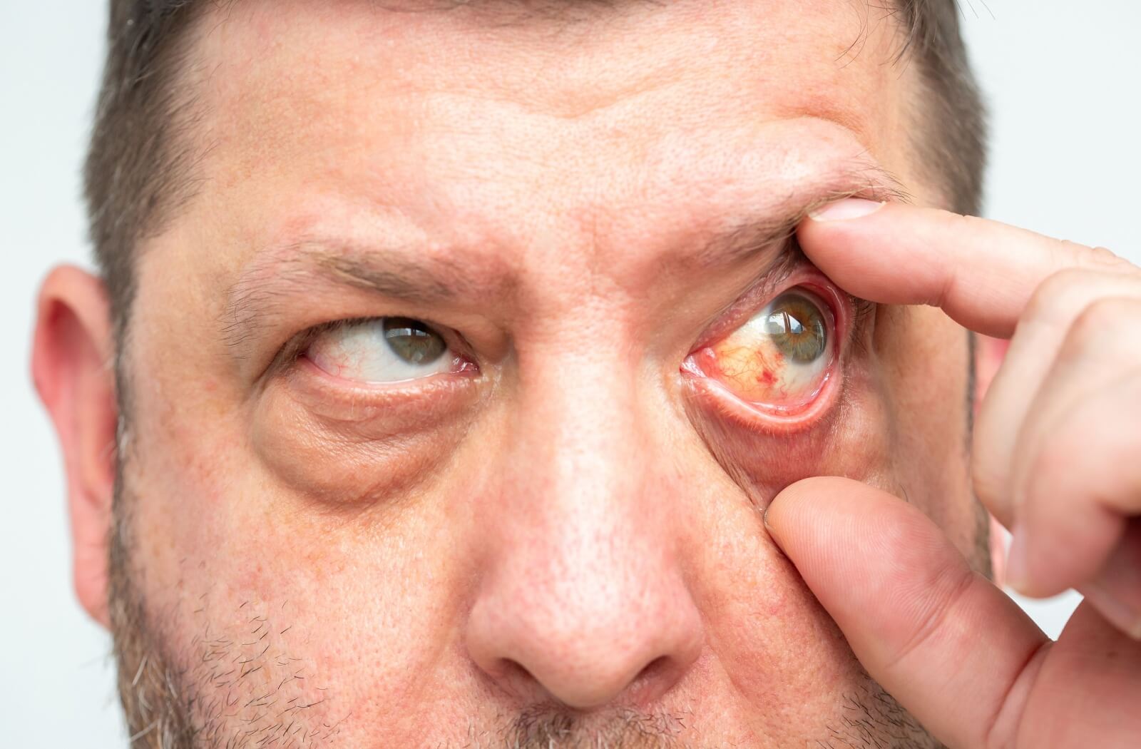 A man with pink eye in his right eye uses his right thumb and index fingers to spread his eyelid open.