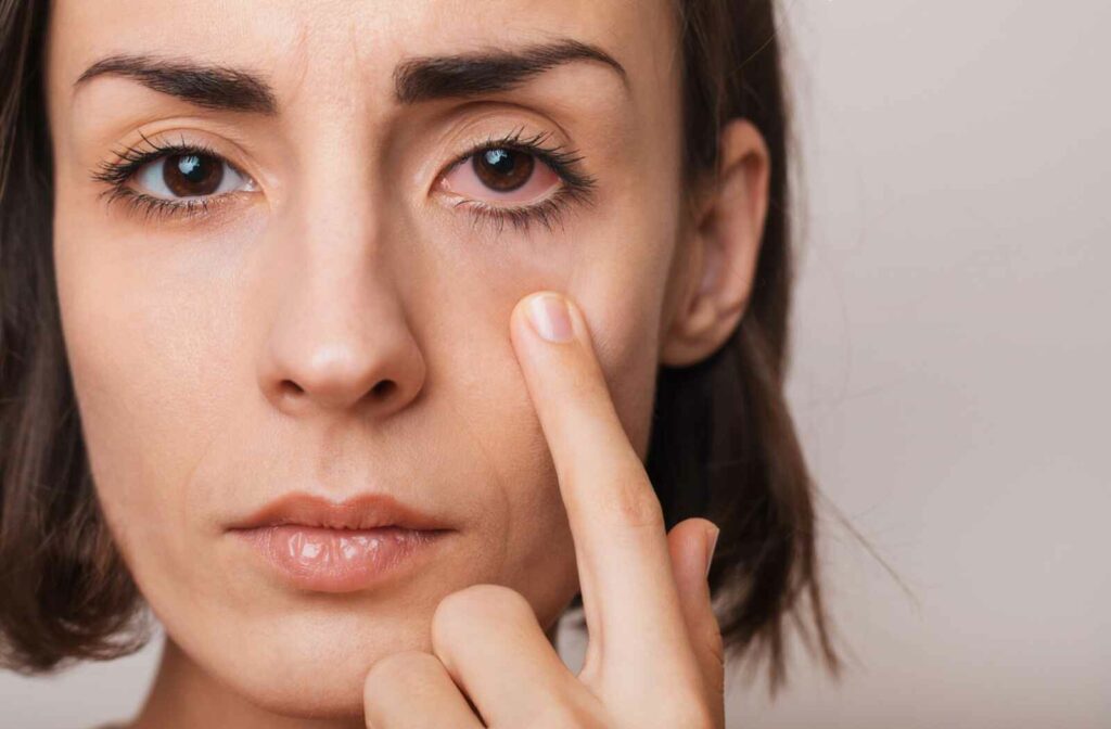 A woman pulls her lower eyelid with one finger, exposing her red, dry irritated eye with Meibomian Gland Dysfunction